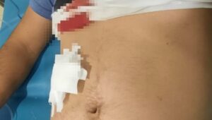 Tak Terima Ditegur, Pengemudi Bentor Jadi Korban Penikaman